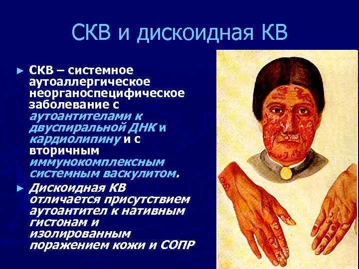 СКВ и дискоидная КВ ► СКВ – системное аутоаллергическое неорганоспецифическое заболевание с аутоантителами к