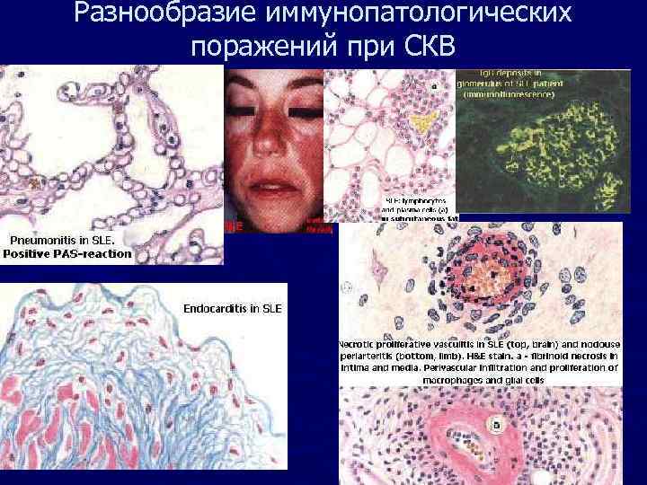 Разнообразие иммунопатологических поражений при СКВ 