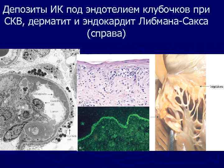 Депозиты ИК под эндотелием клубочков при СКВ, дерматит и эндокардит Либмана-Сакса (справа) 