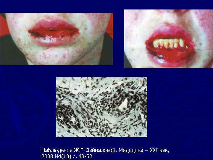 Наблюдение Ж. Г. Зейналовой, Медицина – XXI век, 2008 N 4(13) c. 48 -52