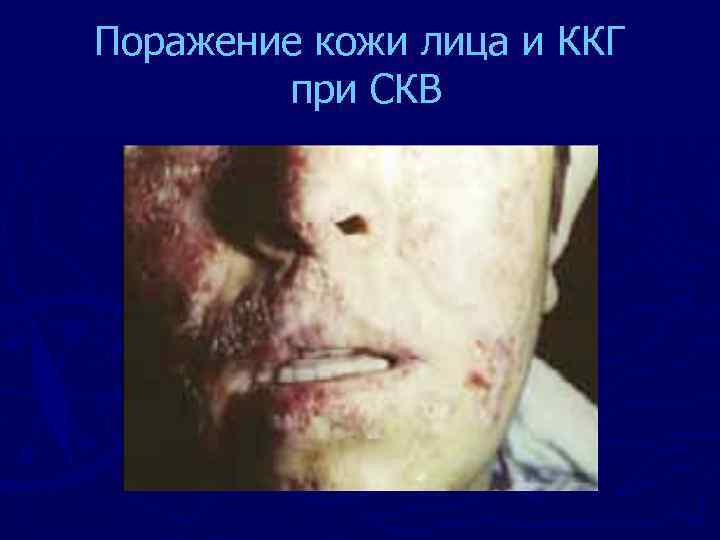 Поражение кожи лица и ККГ при СКВ 