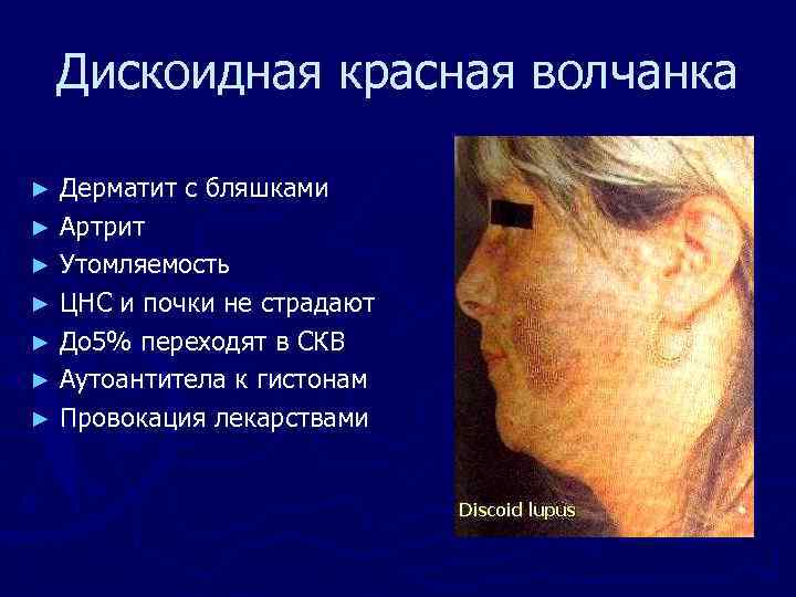 Дискоидная красная волчанка Дерматит с бляшками ► Артрит ► Утомляемость ► ЦНС и почки