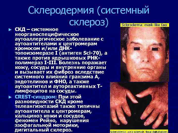 Склеродермия (системный склероз) СКД – системное неорганоспецифическое аутоаллергическое заболевание с аутоантителами к центромерам хромосом