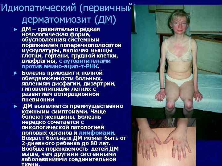 Идиопатический (первичный) дерматомиозит (ДМ) ДМ – сравнительно редкая нозологическая форма, обусловленная системным поражением поперечнополосатой