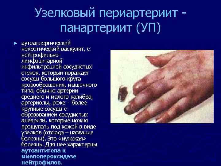 Узелковый периартериит панартериит (УП) ► аутоаллергический некротический васкулит, с нейтрофильнолимфоцитарной инфильтрацией сосудистых стенок, который