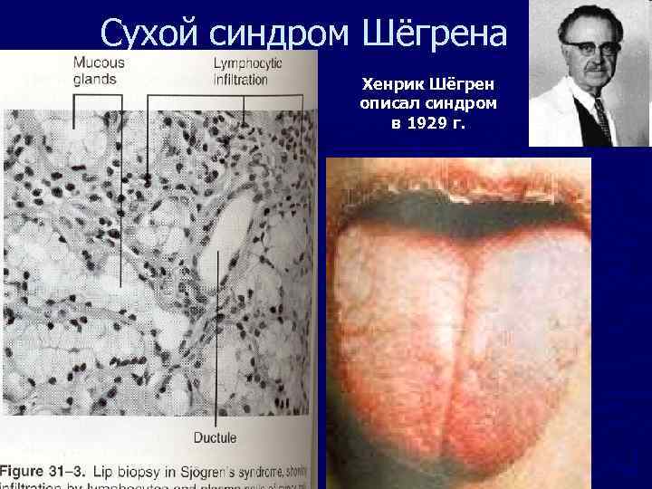 Сухой синдром Шёгрена Хенрик Шёгрен описал синдром в 1929 г. 