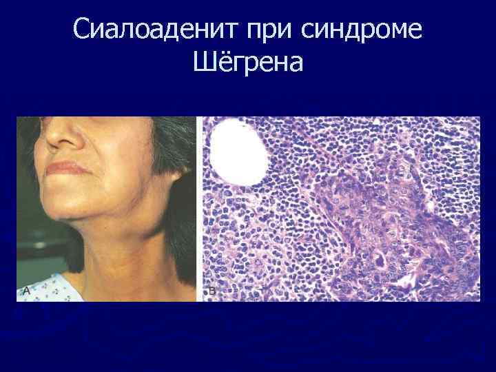 Сиалоаденит при синдроме Шёгрена 