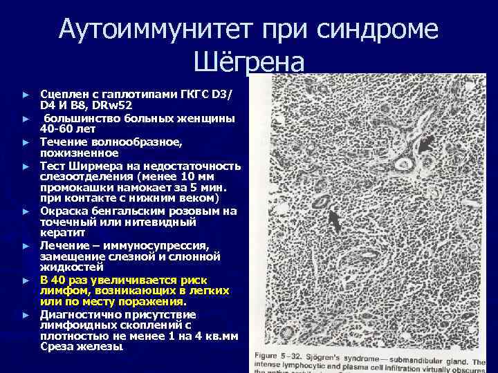 Аутоиммунитет при синдроме Шёгрена ► ► ► ► Сцеплен c гаплотипами ГКГС D 3/