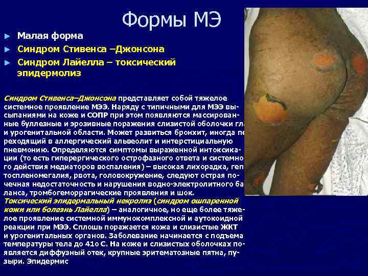 Формы МЭ Малая форма ► Синдром Стивенса –Джонсона ► Синдром Лайелла – токсический эпидермолиз
