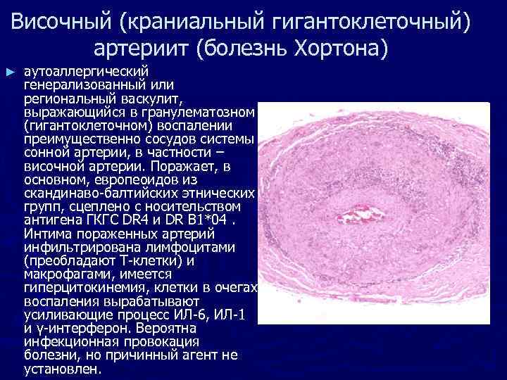 Височный (краниальный гигантоклеточный) артериит (болезнь Хортона) ► аутоаллергический генерализованный или региональный васкулит, выражающийся в