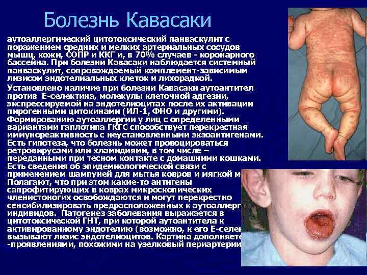 Болезнь Кавасаки аутоаллергический цитотоксический панваскулит с поражением средних и мелких артериальных сосудов мышц, кожи,