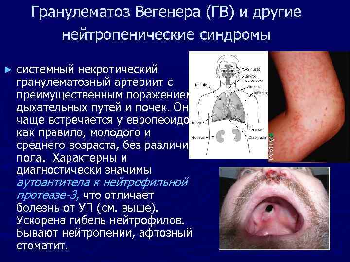 Гранулематоз Вегенера (ГВ) и другие нейтропенические синдромы ► системный некротический гранулематозный артериит с преимущественным