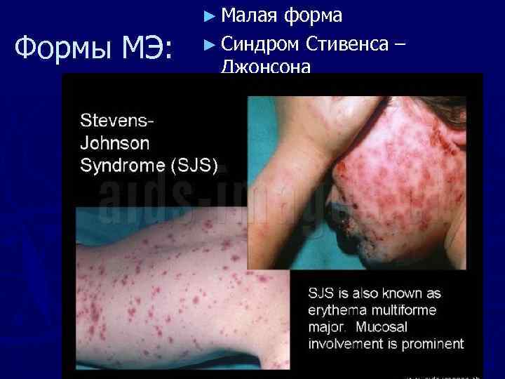 ► Малая Формы МЭ: форма ► Синдром Стивенса – Джонсона 
