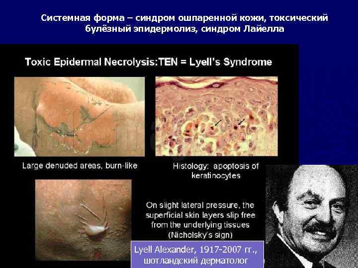 Системная форма – синдром ошпаренной кожи, токсический булёзный эпидермолиз, синдром Лайелла Lyell Alexander, 1917