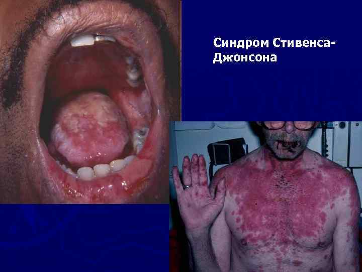 Синдром Стивенса. Джонсона 
