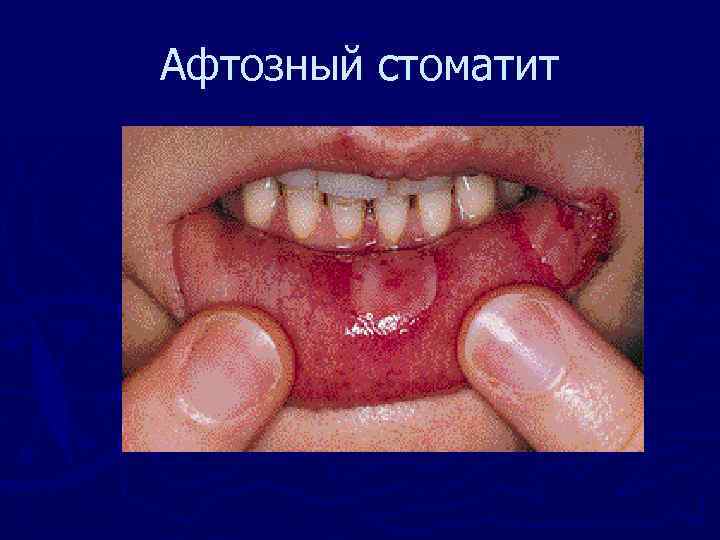 Афтозный стоматит 