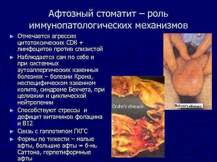 Афтозный стоматит – роль иммунопатологических механизмов ► ► ► Отмечается агрессия цитотоксических CD 8