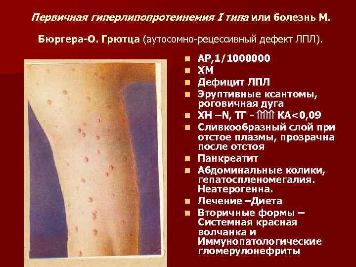 Первичная гиперлипопротеинемия I типа или болезнь М. Бюргера О. Грютца (аутосомно-рецессивный дефект ЛПЛ). n