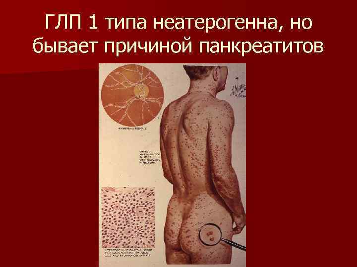 ГЛП 1 типа неатерогенна, но бывает причиной панкреатитов 