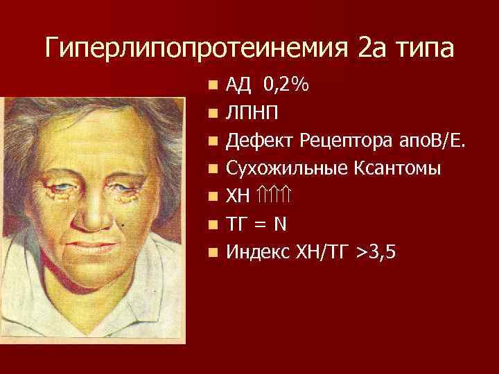 Гиперлипопротеинемия 2 а типа n n n n АД 0, 2% ЛПНП Дефект Рецептора