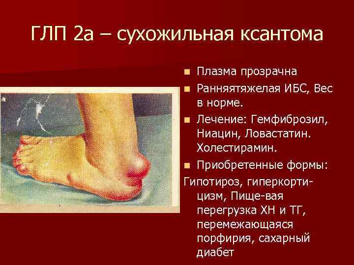 ГЛП 2 а – сухожильная ксантома Плазма прозрачна n Ранняятяжелая ИБС, Вес в норме.