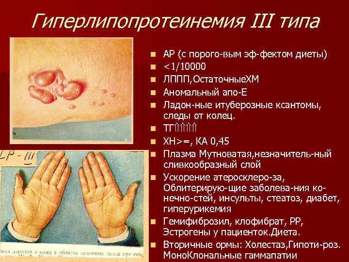 Гиперлипопротеинемия III типа n n n АР (с порого-вым эф-фектом диеты) <1/10000 ЛППП, Остаточные.