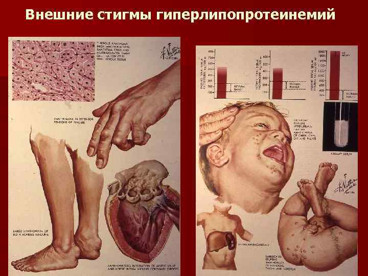Внешние стигмы гиперлипопротеинемий 