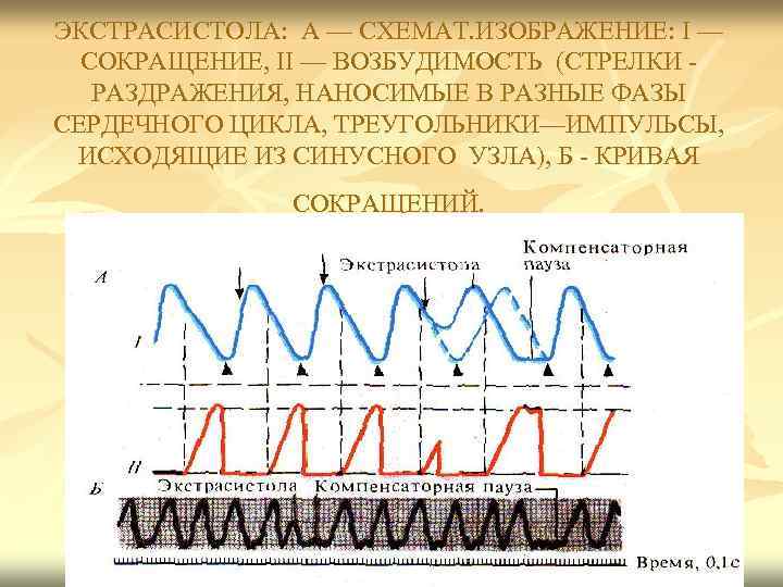 ЭКСТРАСИСТОЛА: А — СХЕМАТ. ИЗОБРАЖЕНИЕ: I — СОКРАЩЕНИЕ, II — ВОЗБУДИМОСТЬ (СТРЕЛКИ - РАЗДРАЖЕНИЯ,