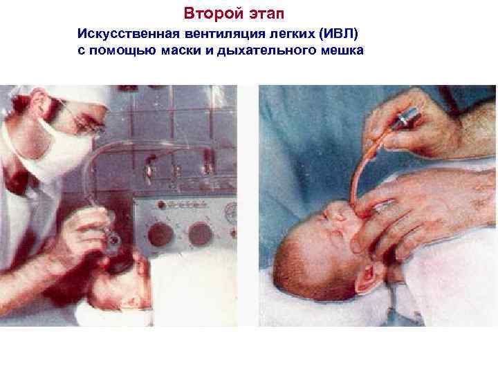Второй этап Искусственная вентиляция легких (ИВЛ) с помощью маски и дыхательного мешка 