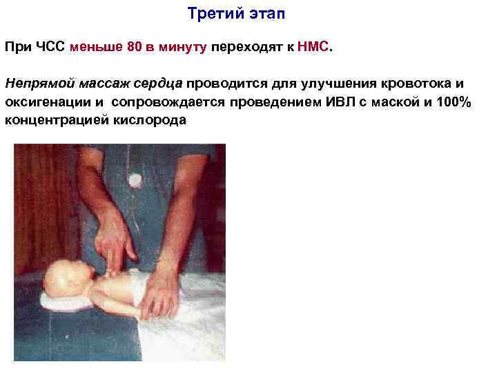 Третий этап При ЧСС меньше 80 в минуту переходят к НМС. Непрямой массаж сердца