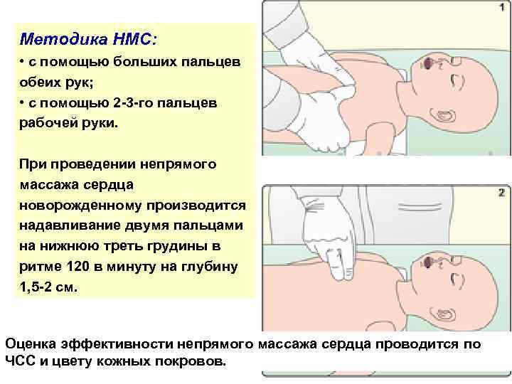 Методика НМС: • с помощью больших пальцев обеих рук; • с помощью 2 -3