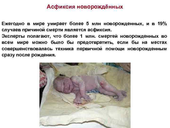 Асфиксия новорождённых Ежегодно в мире умирает более 5 млн новорожденных, и в 19% случаев