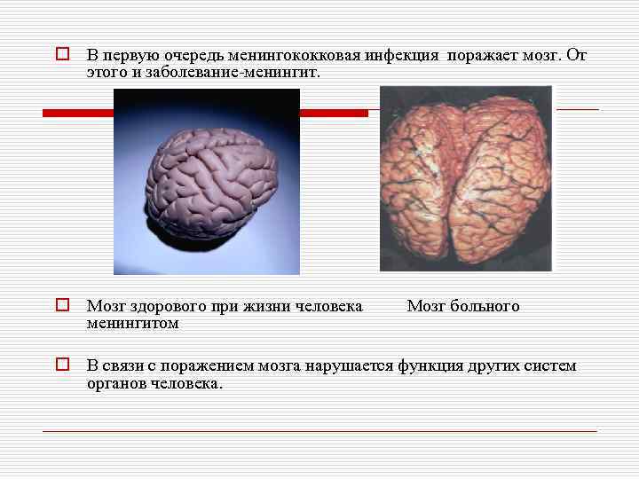 o В первую очередь менингококковая инфекция поражает мозг. От этого и заболевание-менингит. o Мозг