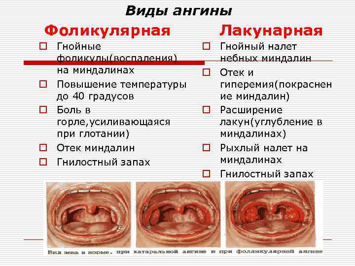 Виды ангины Фоликулярная o Гнойные фоликулы(воспаления) на миндалинах o Повышение температуры до 40 градусов