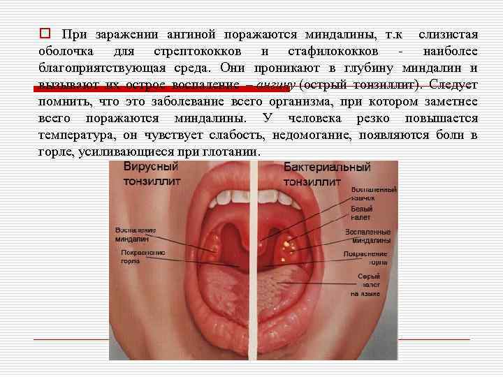 o При заражении ангиной поражаются миндалины, т. к слизистая оболочка для стрептококков и стафилококков