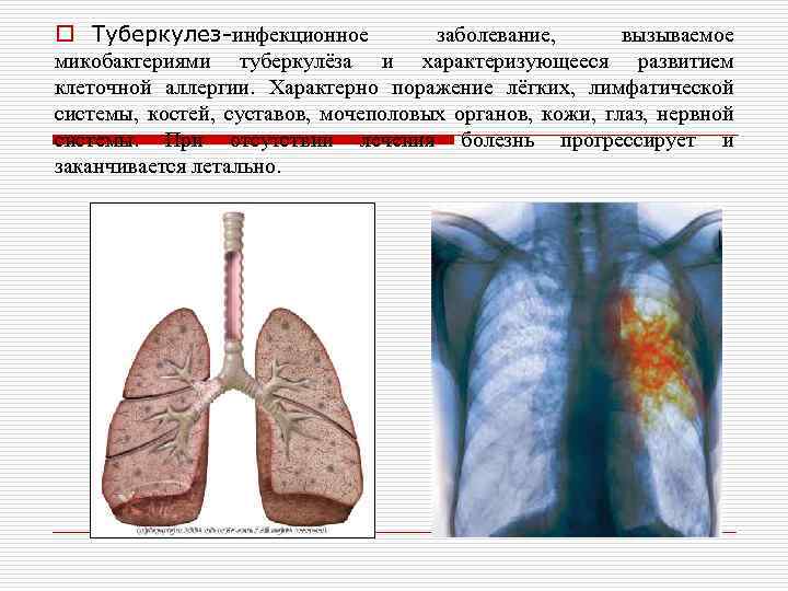 o Туберкулез-инфекционное заболевание, вызываемое микобактериями туберкулёза и характеризующееся развитием клеточной аллергии. Характерно поражение лёгких,