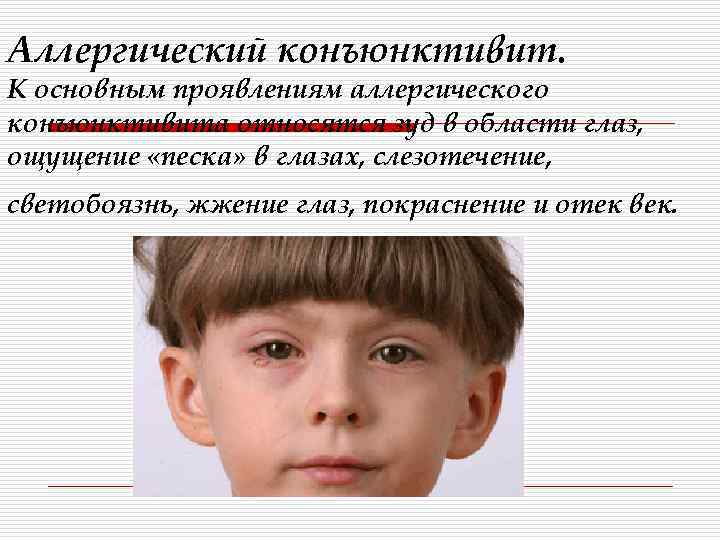 Аллергический конъюнктивит. К основным проявлениям аллергического конъюнктивита относятся зуд в области глаз, ощущение «песка»