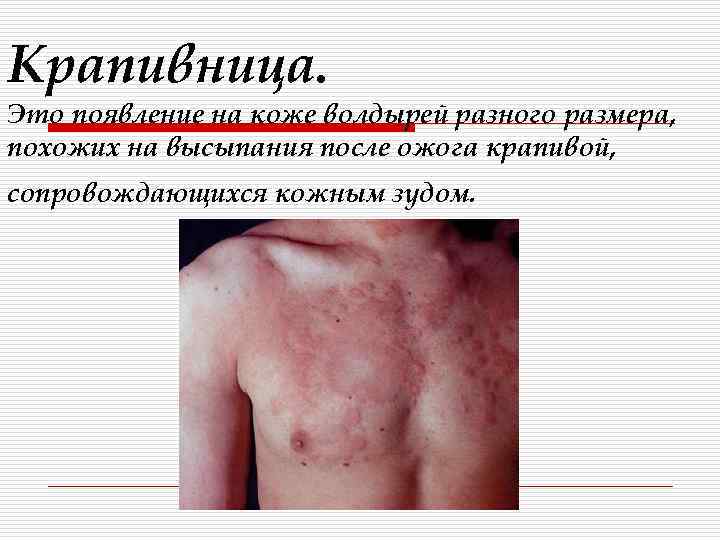 Крапивница. Это появление на коже волдырей разного размера, похожих на высыпания после ожога крапивой,