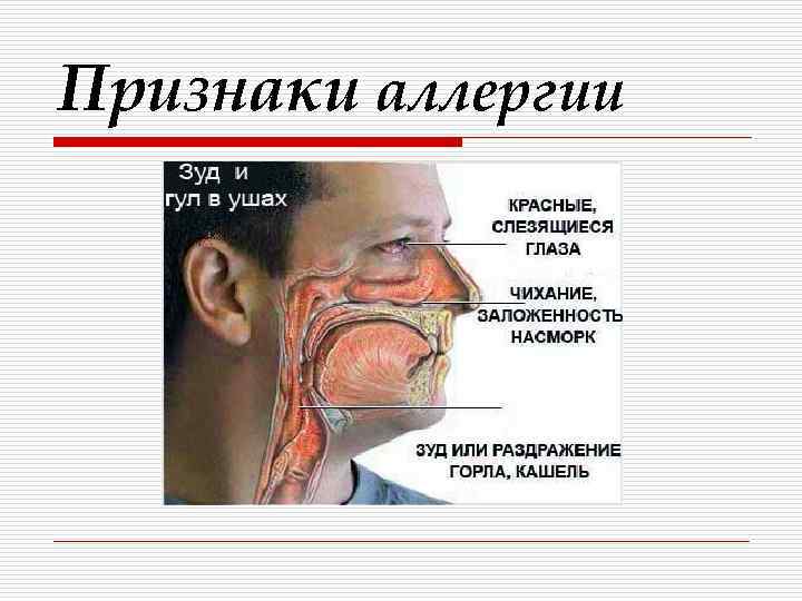 Признаки аллергии 