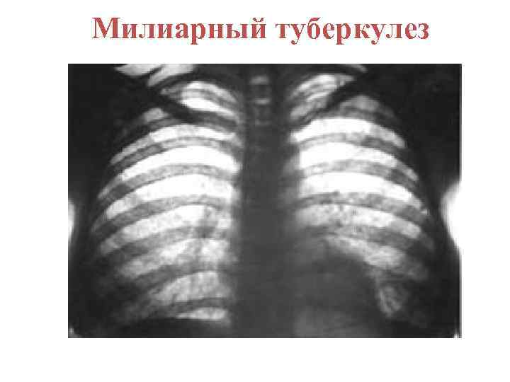 Милиарный туберкулез 