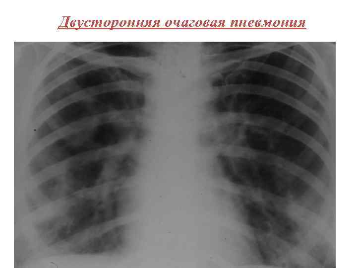 Двусторонняя очаговая пневмония 