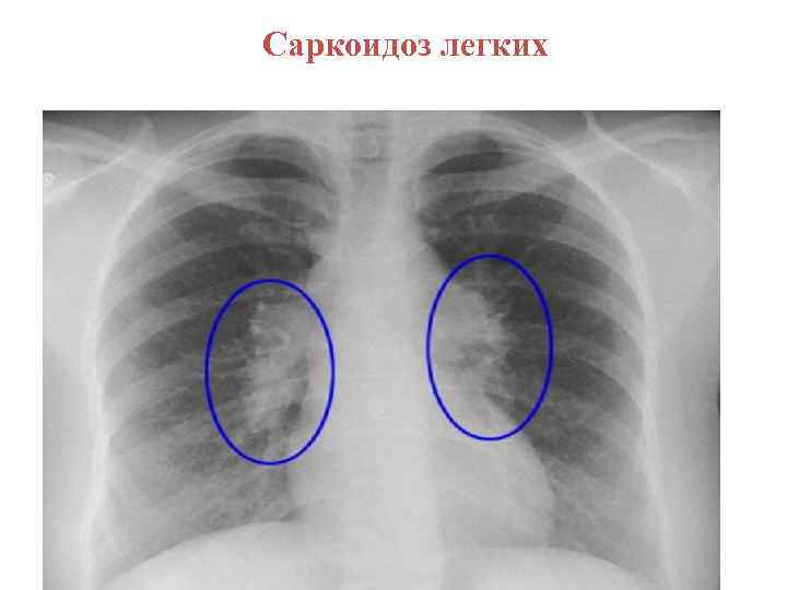Саркоидоз легких 