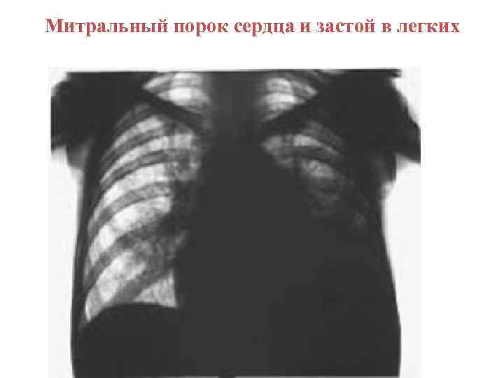 Митральный порок сердца и застой в легких 