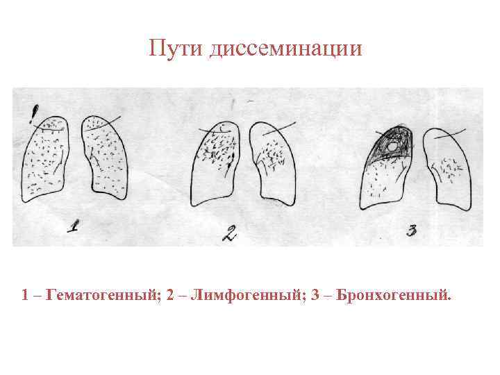 Пути диссеминации 1 – Гематогенный; 2 – Лимфогенный; 3 – Бронхогенный. 