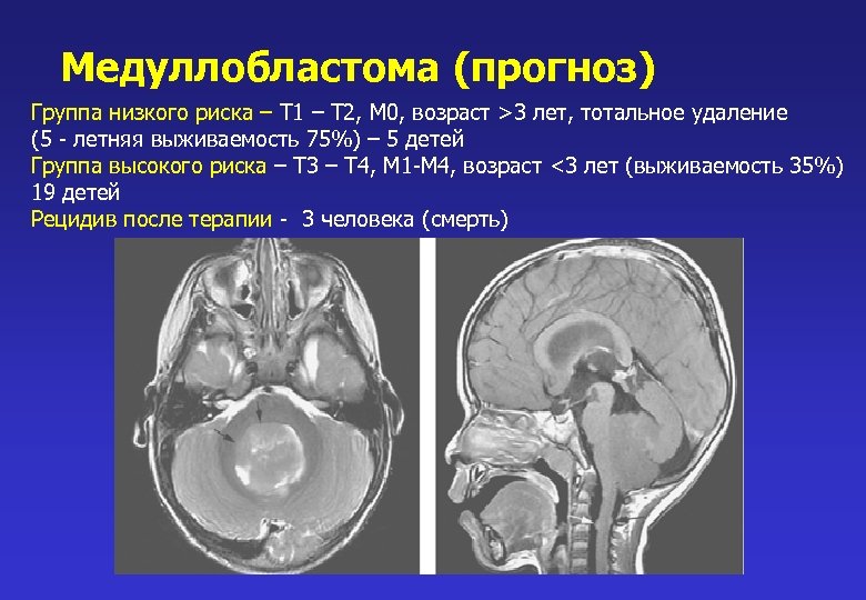 Медуллобластома (прогноз) Группа низкого риска – Т 1 – Т 2, М 0, возраст