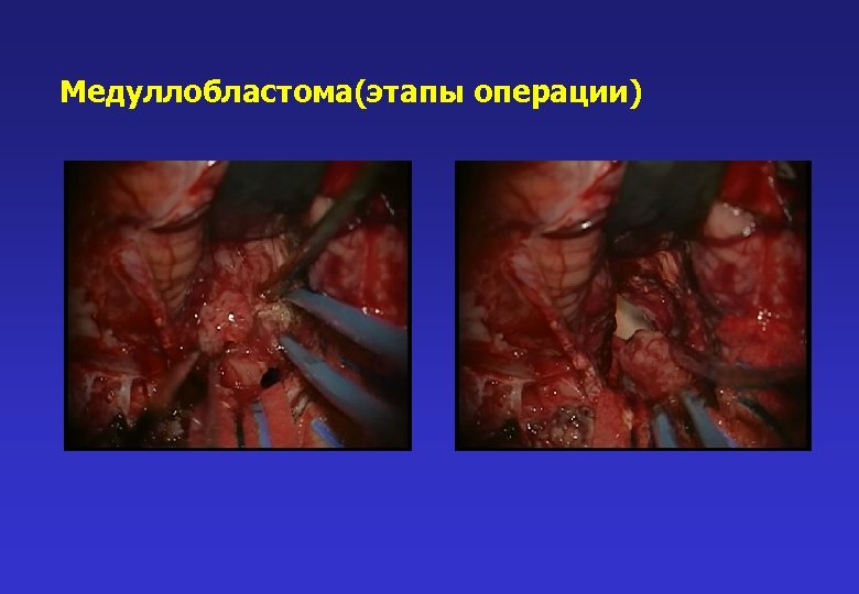Медуллобластома(этапы операции) 