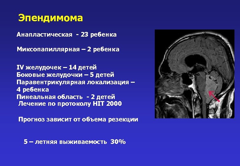 Эпендимома Анапластическая - 23 ребенка Миксопапиллярная – 2 ребенка IV желудочек – 14 детей