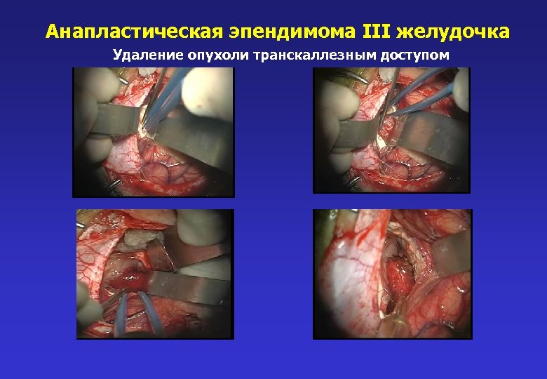 Анапластическая эпендимома III желудочка Удаление опухоли транскаллезным доступом 