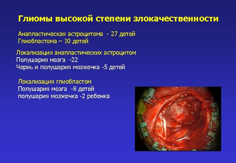 Глиомы высокой степени злокачественности Анапластическая астроцитома - 27 детей Глиобластома – 10 детей Локализация