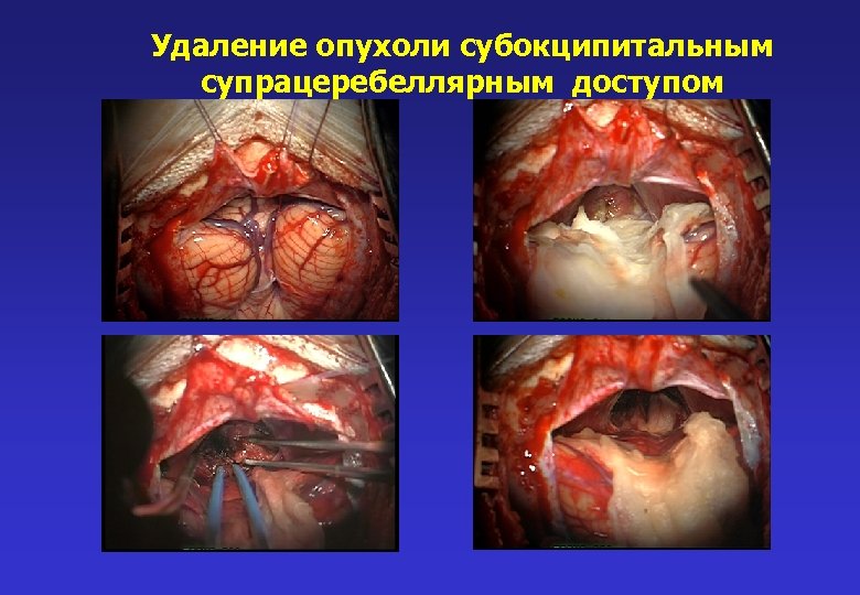 Удаление опухоли субокципитальным супрацеребеллярным доступом 